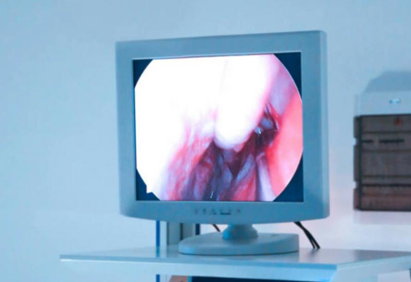 内镜检查发现息肉怎么办？消化内科医生这样说！