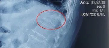 没磕没碰，怎么就脊柱骨折了？原来是因为老年人的这个常见病！