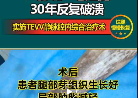 来看视频丨女子&ldquo;老烂腿&rdquo;30年，在陕西冶金医院治疗后&ldquo;烂腿&rdquo;慢慢恢复