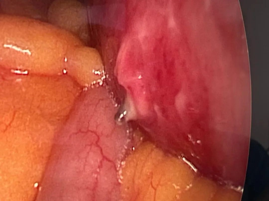 &ldquo;万万没有想到，一枚枣核差点要了我的命&rdquo;