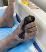 糖尿病足丨忽视小病，现在后悔不已...