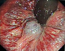 无痛 快速 解决痔疮丨陕西冶金医院技术--消化内镜下治疗痔疮！