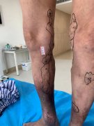 双下肢大隐静脉曲张伴血栓，陕西冶金医院血管外科团队再出手