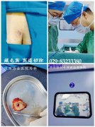 骶尾部出现一个&ldquo;结节&rdquo;！怎么回事？（文内有图）