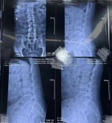 【冶金动态】陕西冶金医院成功开展OLIF​腰椎微创椎体间融合术！